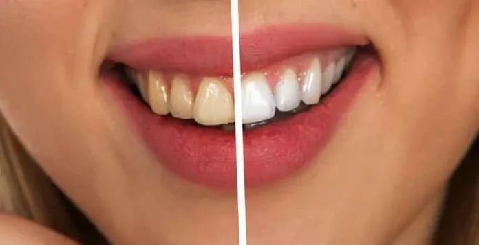 Zähne selber heilen