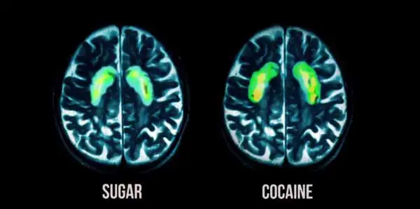 Zucker reagiert im Gehirn wie Kokain oder Heroin