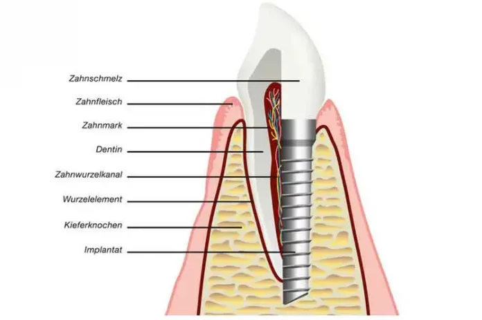 Zahnimplantate für einen langfristigen Zahnersatz
